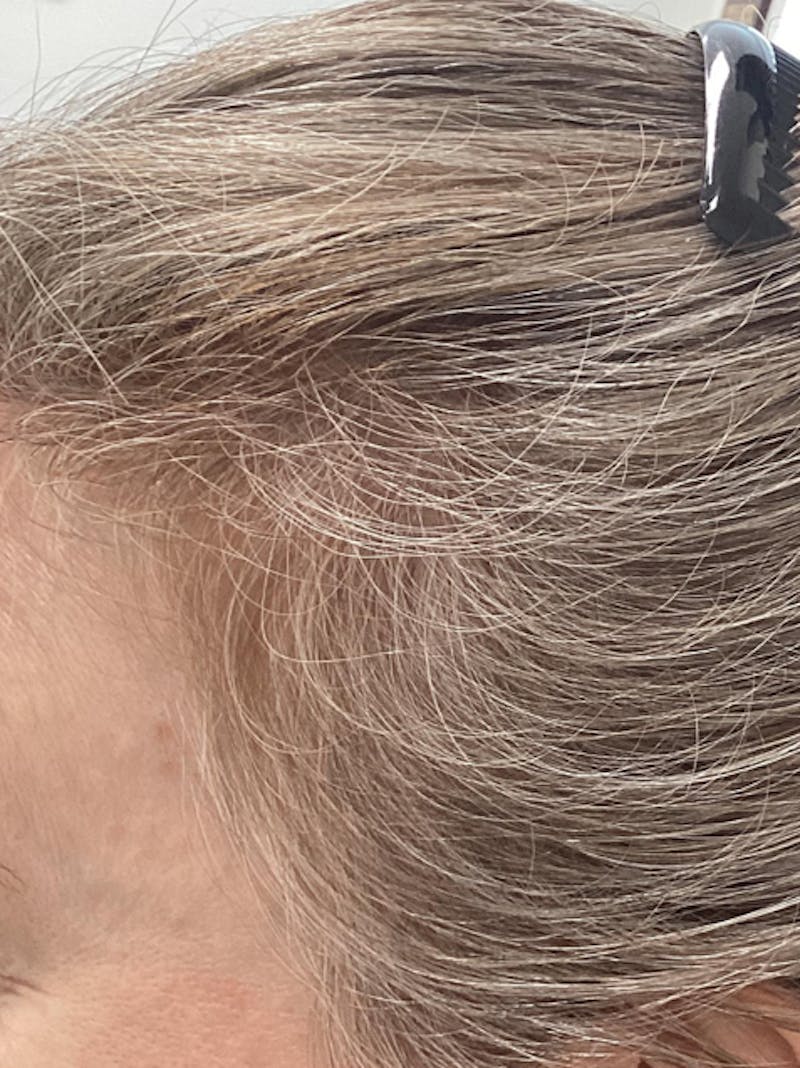 Low Level Laser Therapy Before & After Gallery - Patient 411523 - Image 2