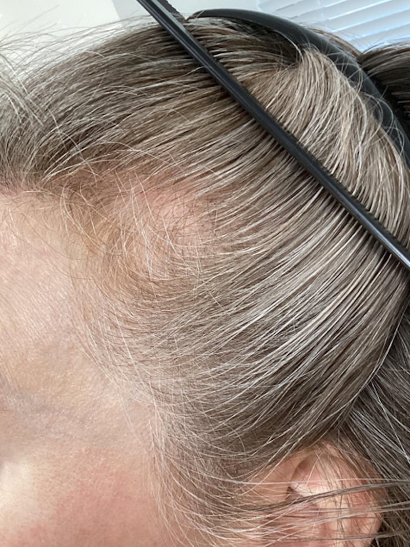Low Level Laser Therapy Before & After Gallery - Patient 411523 - Image 1