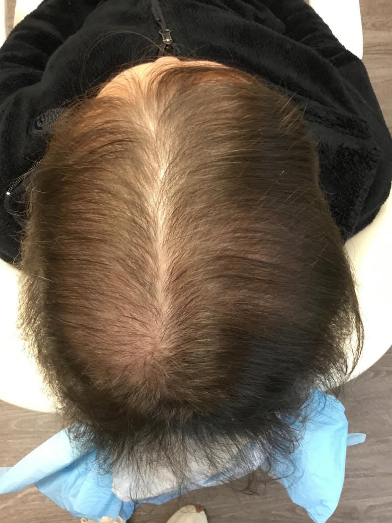 Low Level Laser Therapy Before & After Gallery - Patient 309774 - Image 2