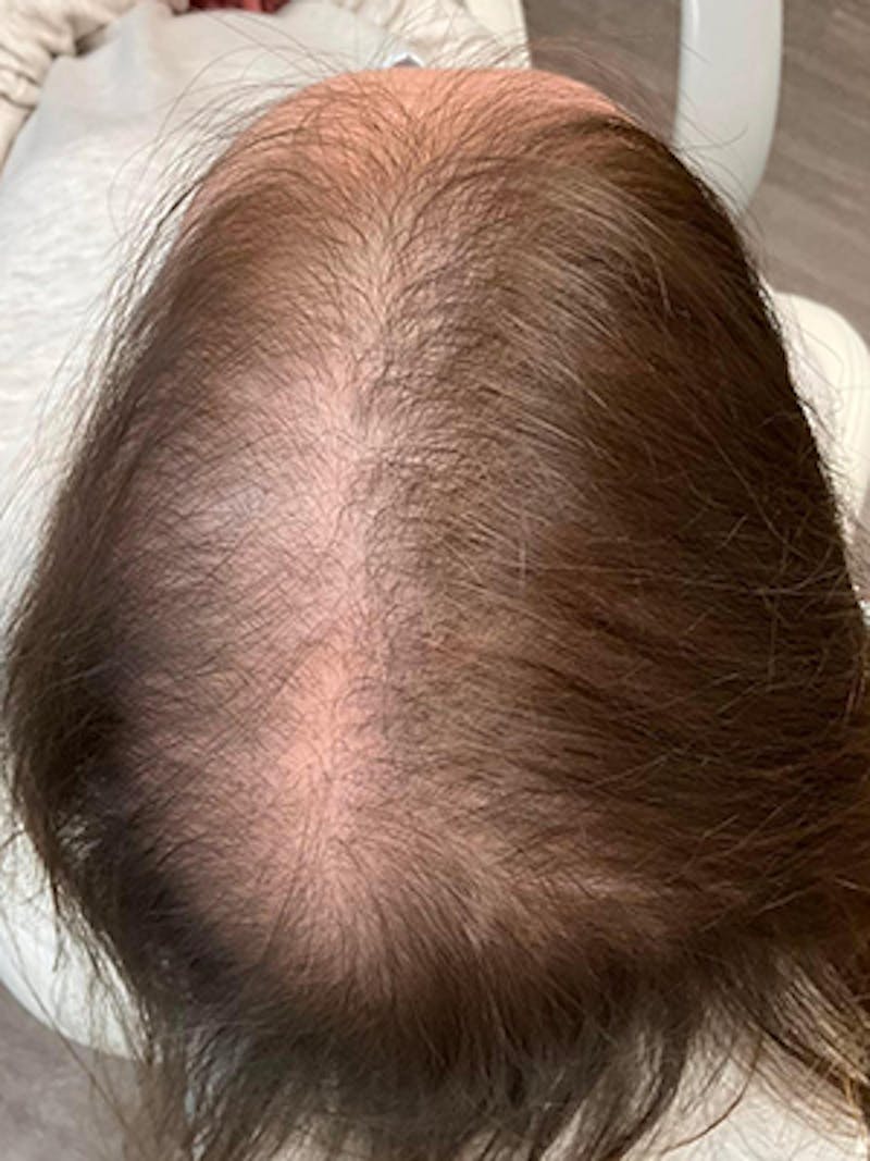 Low Level Laser Therapy Before & After Gallery - Patient 309774 - Image 1