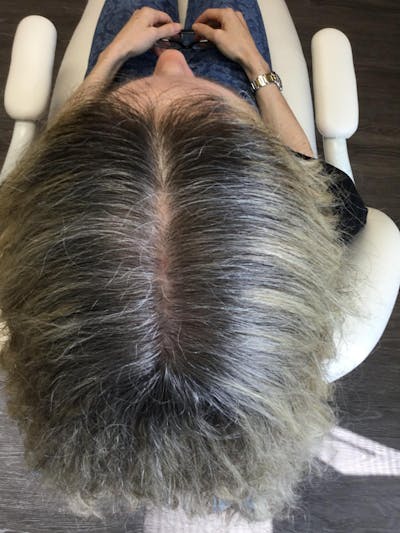Painless PRP Before & After Gallery - Patient 389806 - Image 2