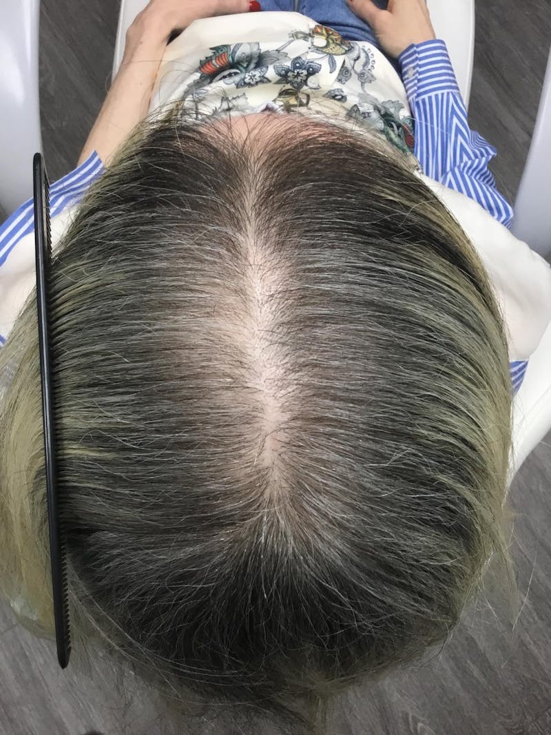 Painless PRP Before & After Gallery - Patient 389806 - Image 1