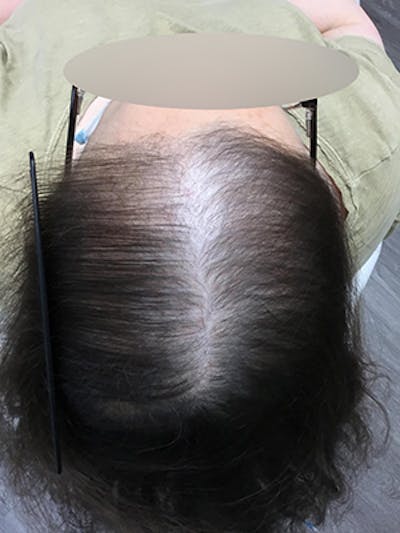 Androgenic Alopecia Before & After Gallery - Patient 215424 - Image 2
