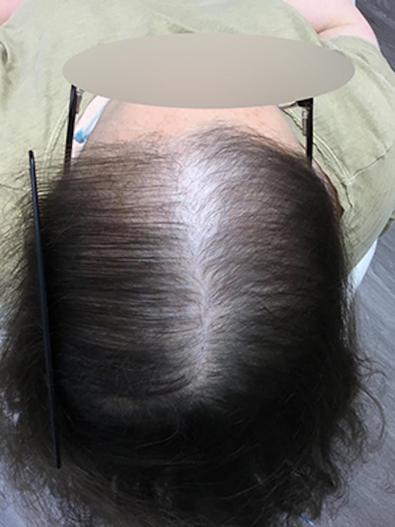 Low Level Laser Therapy Before & After Gallery - Patient 420858 - Image 2