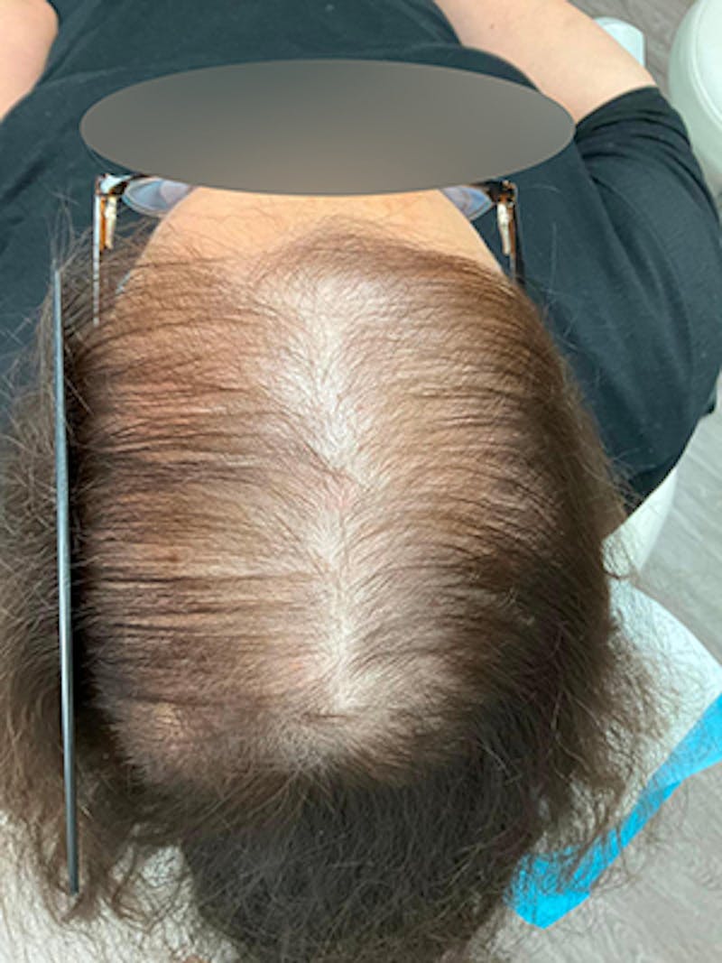 Low Level Laser Therapy Before & After Gallery - Patient 420858 - Image 1