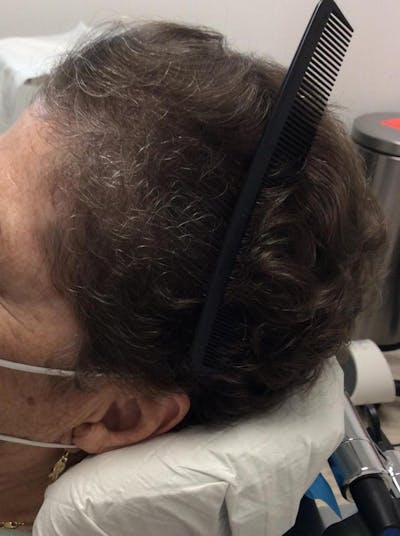 Androgenic Alopecia Before & After Gallery - Patient 274152 - Image 2
