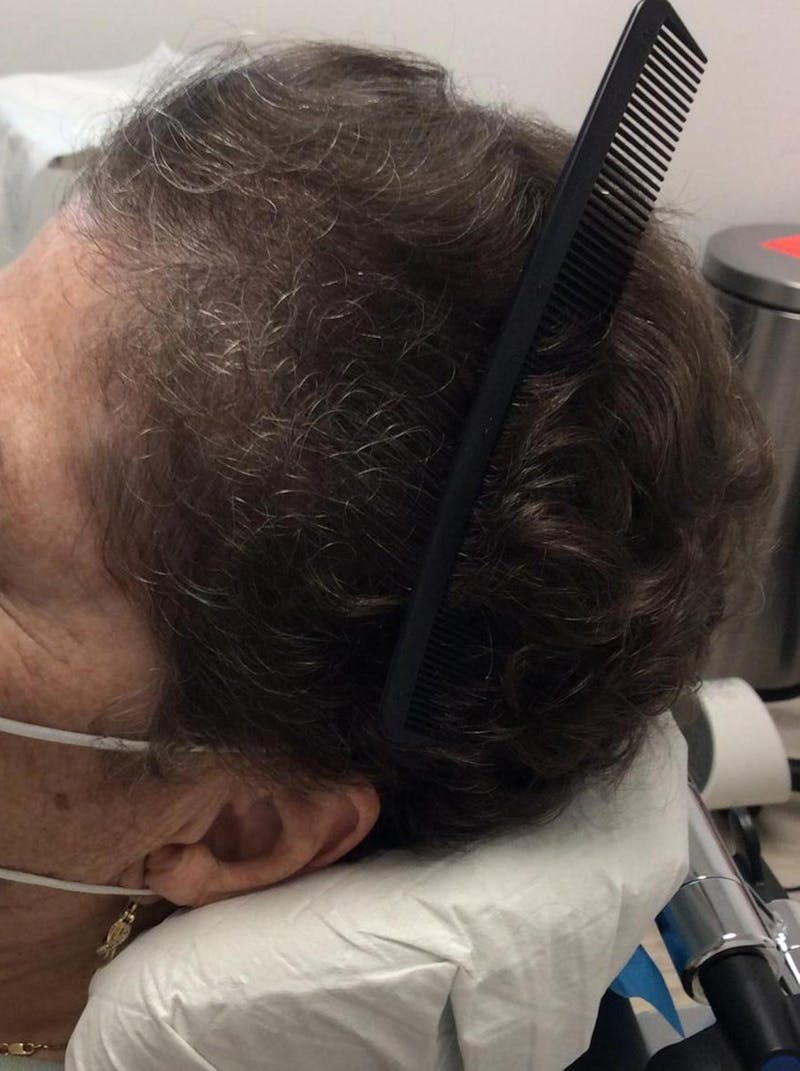 Androgenic Alopecia Before & After Gallery - Patient 274152 - Image 2