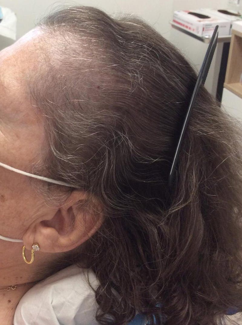 Androgenic Alopecia Before & After Gallery - Patient 274152 - Image 1