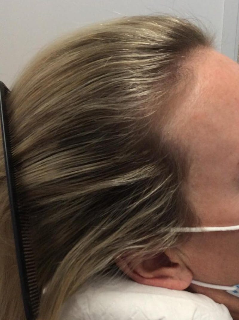 Androgenic Alopecia Before & After Gallery - Patient 391294 - Image 2