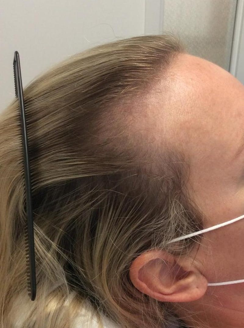 Androgenic Alopecia Before & After Gallery - Patient 391294 - Image 1
