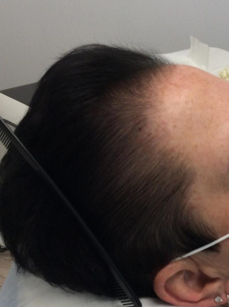 Low Level Laser Therapy Before & After Gallery - Patient 269472 - Image 2