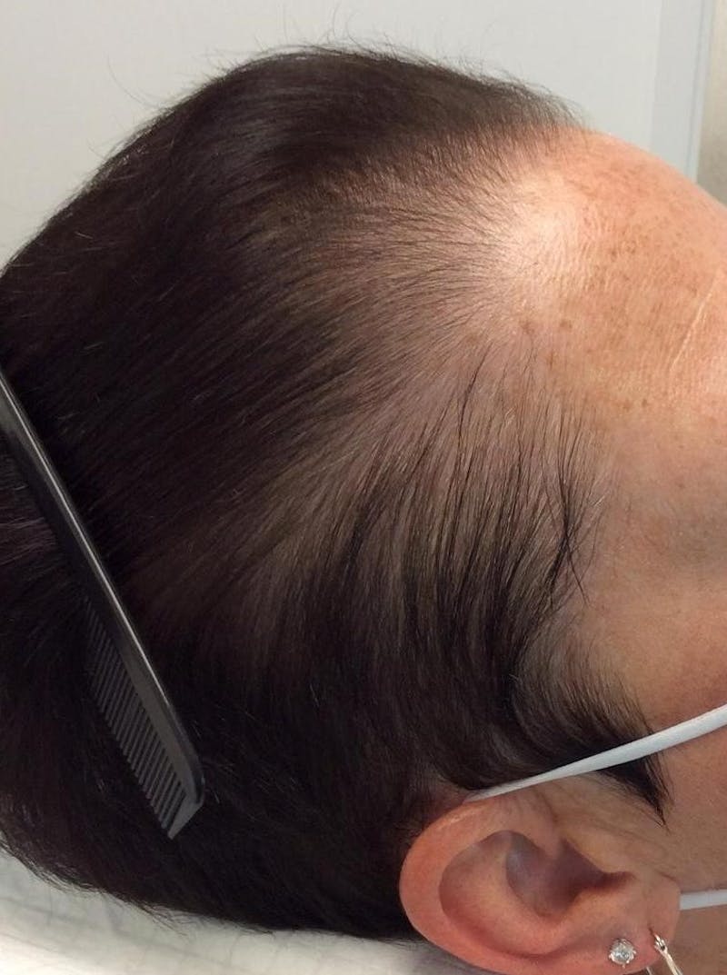 Low Level Laser Therapy Before & After Gallery - Patient 269472 - Image 1