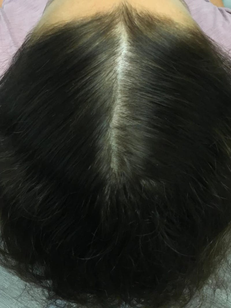 Painless PRP Before & After Gallery - Patient 397679 - Image 2
