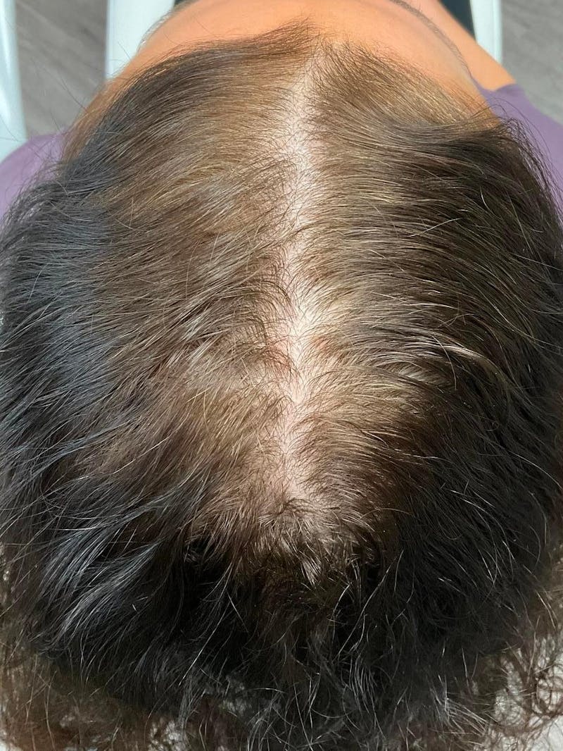 Painless PRP Before & After Gallery - Patient 397679 - Image 1
