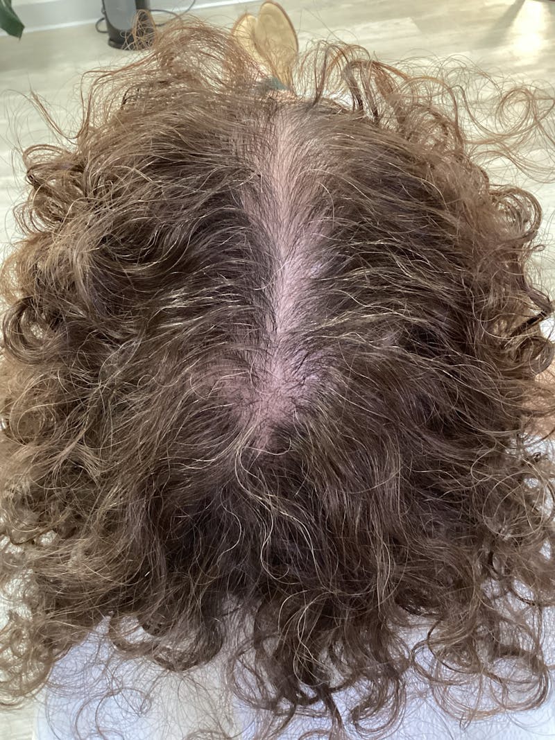 Optimal Platelet Concentration™ Therapy Before & After Gallery - Patient 330096 - Image 2