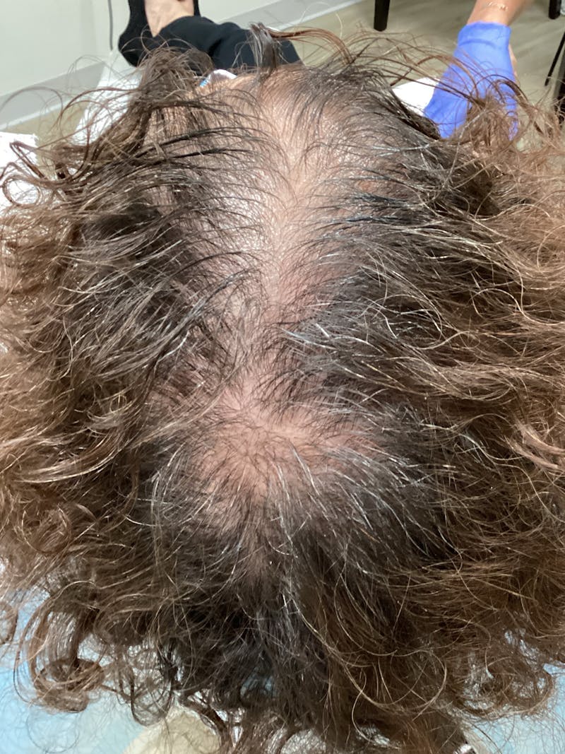 Optimal Platelet Concentration™ Therapy Before & After Gallery - Patient 330096 - Image 1