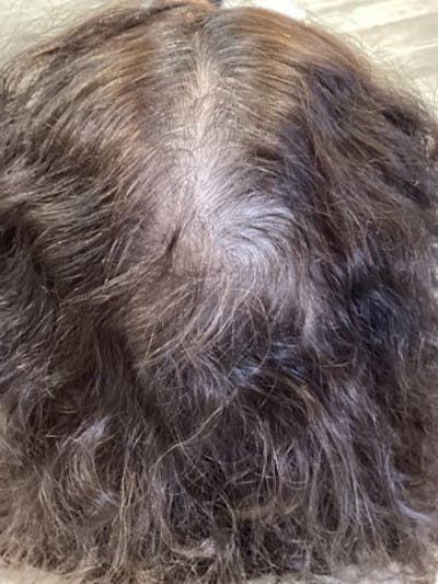 Androgenic Alopecia Before & After Gallery - Patient 232401 - Image 2