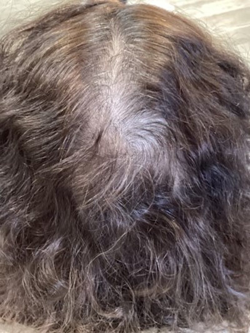 Androgenic Alopecia Before & After Gallery - Patient 232401 - Image 2