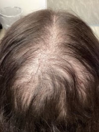 Androgenic Alopecia Before & After Gallery - Patient 232401 - Image 1