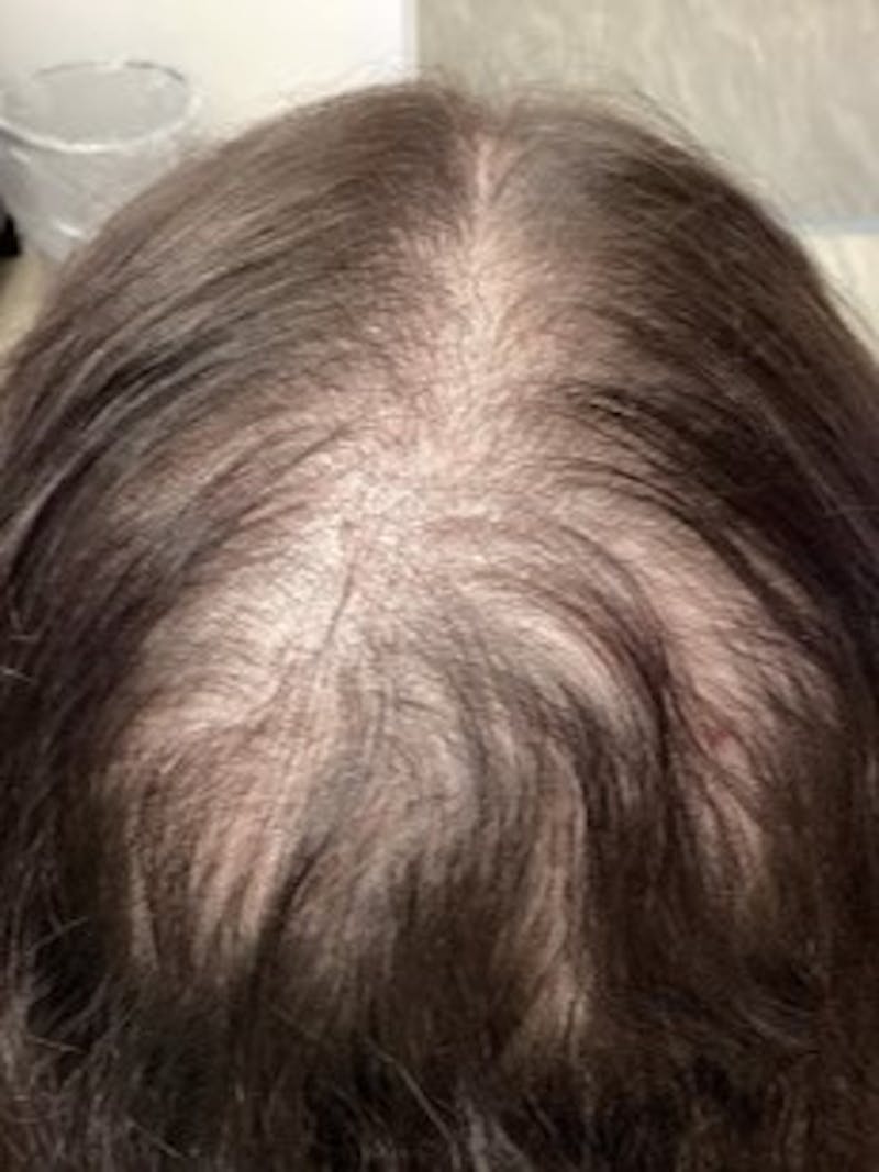 Androgenic Alopecia Before & After Gallery - Patient 232401 - Image 1