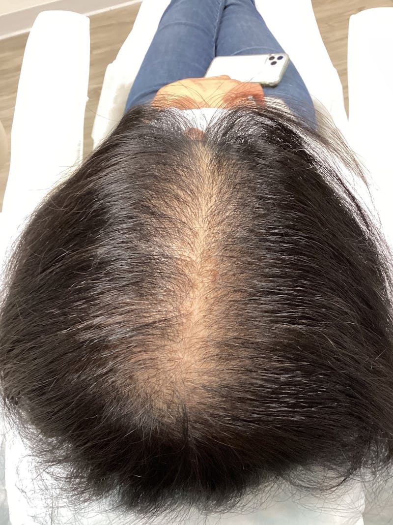 Low Level Laser Therapy Before & After Gallery - Patient 216824 - Image 1