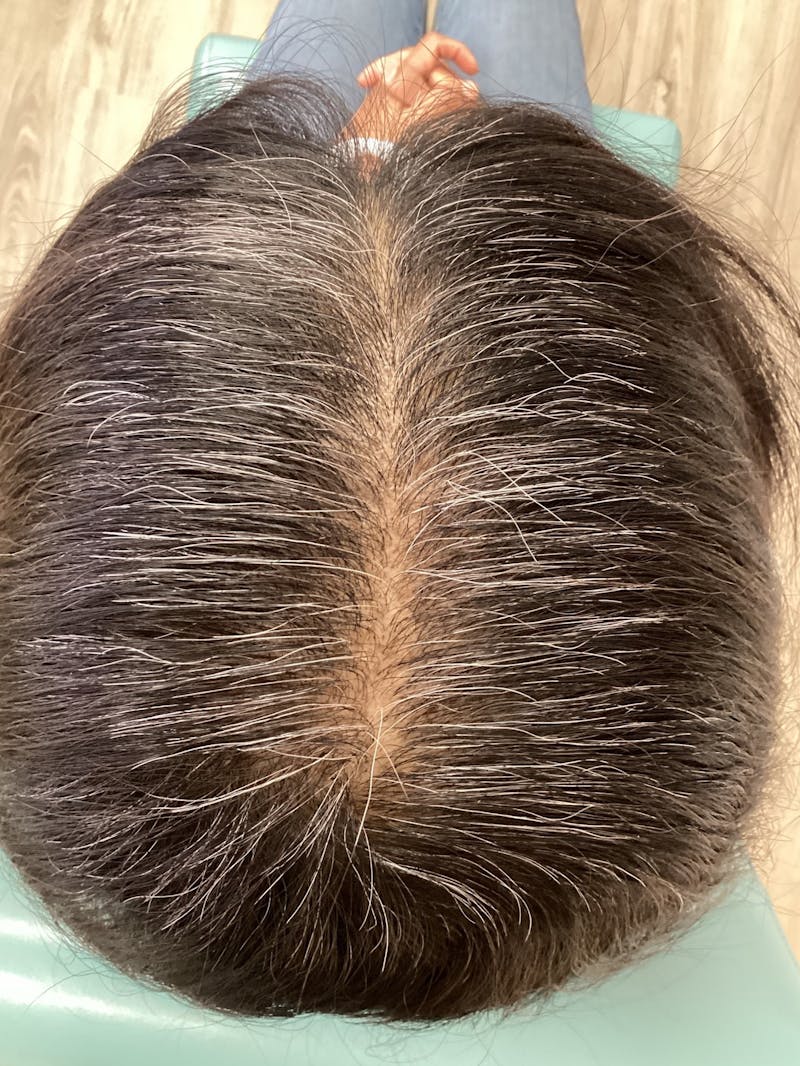 Low Level Laser Therapy Before & After Gallery - Patient 216824 - Image 2