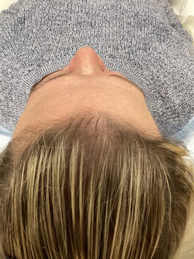 Androgenic Alopecia Before & After Gallery - Patient 200887 - Image 2
