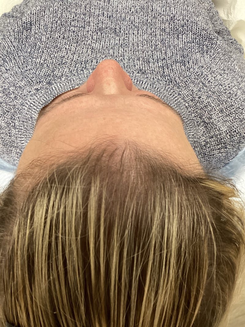 Low Level Laser Therapy Before & After Gallery - Patient 407829 - Image 2