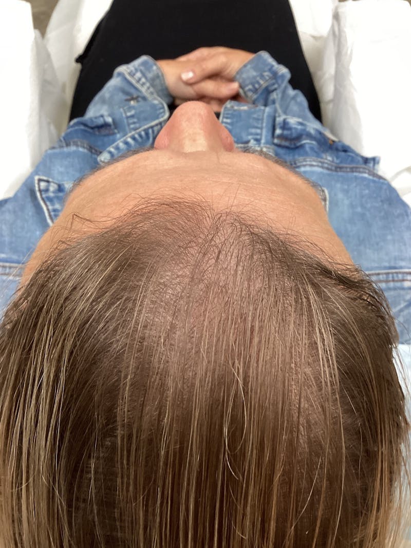 Low Level Laser Therapy Before & After Gallery - Patient 407829 - Image 1