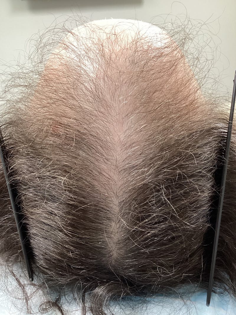 Low Level Laser Therapy Before & After Gallery - Patient 331515 - Image 2