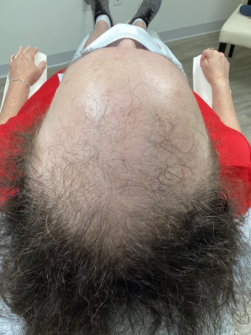 Low Level Laser Therapy Before & After Gallery - Patient 331515 - Image 1