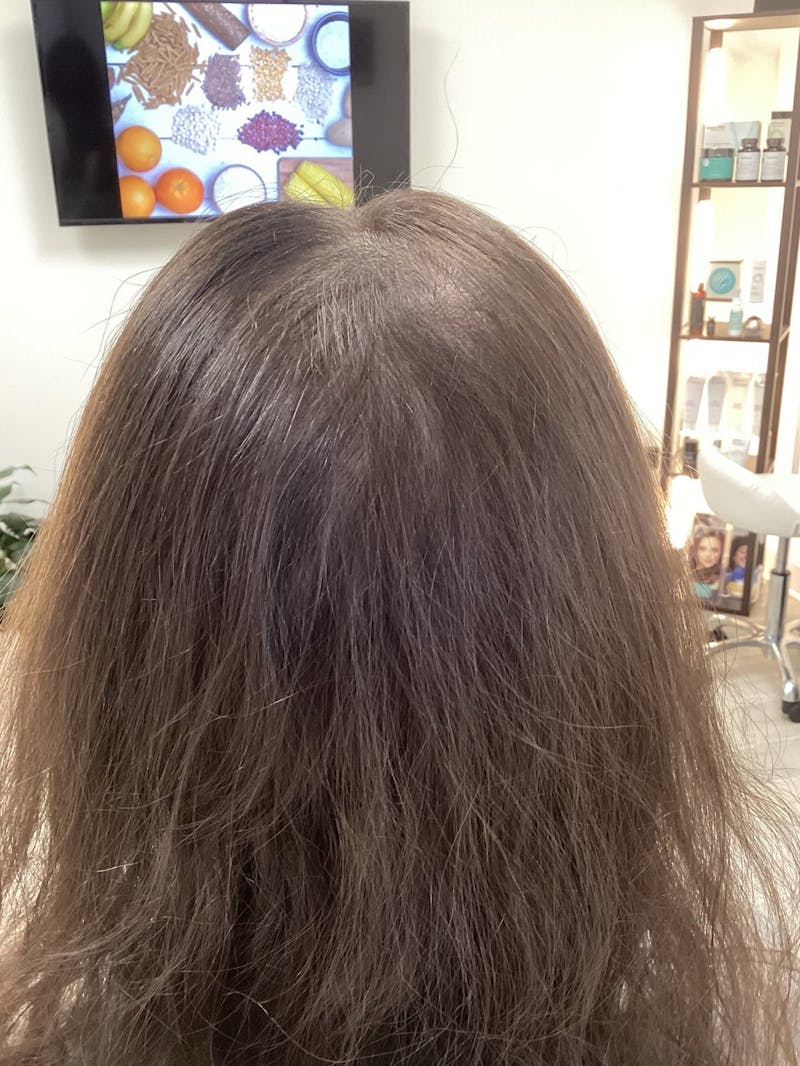 Low Level Laser Therapy Before & After Gallery - Patient 109267 - Image 2