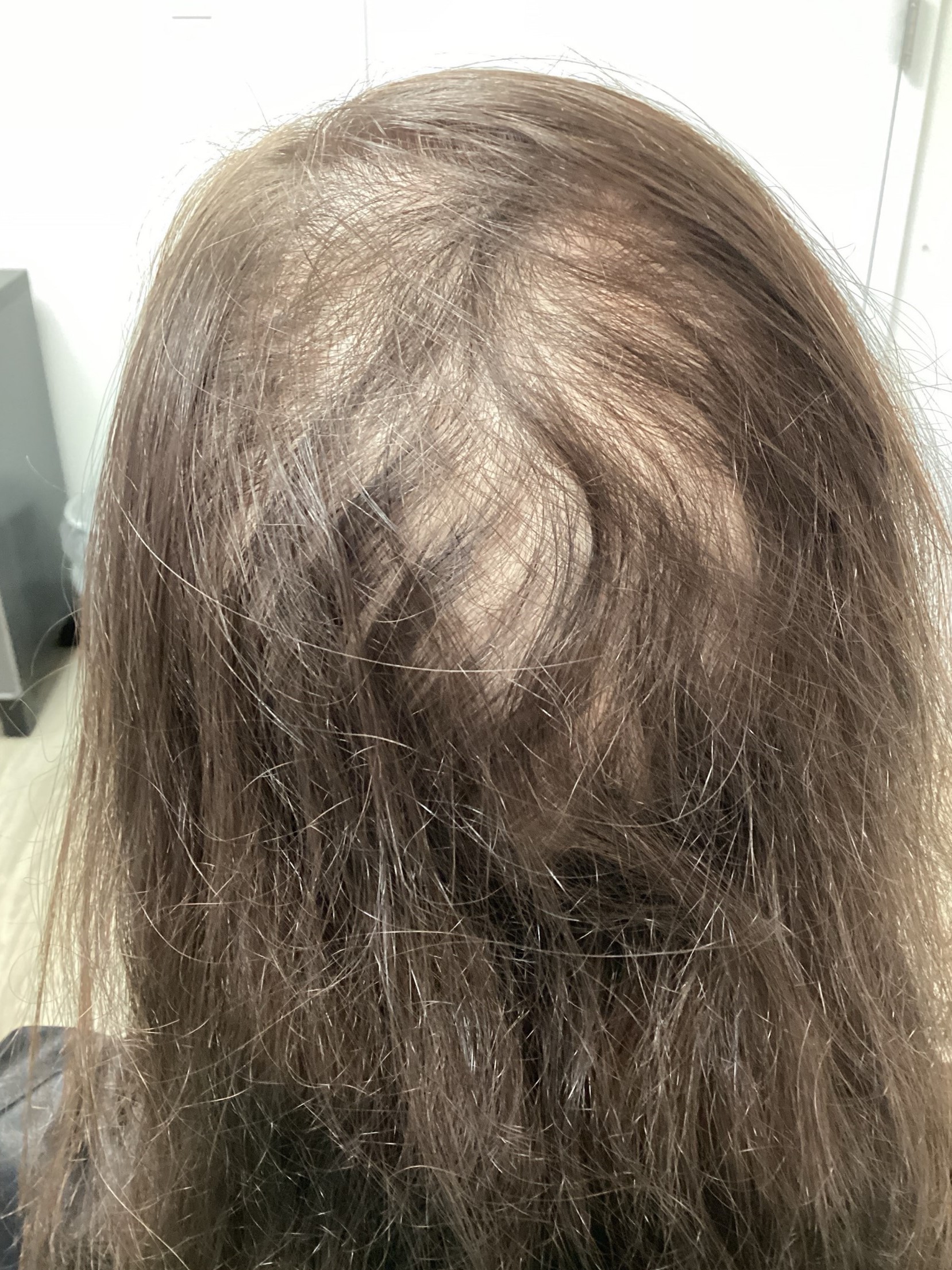 Patient 331634 | Androgenic Alopecia Before & After Photos