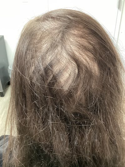 Androgenic Alopecia Before & After Gallery - Patient 331634 - Image 1