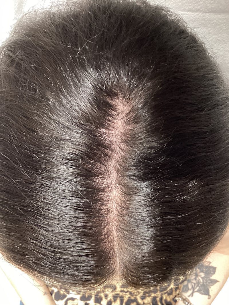 Optimal Platelet Concentration™ Therapy Before & After Gallery - Patient 289639 - Image 2