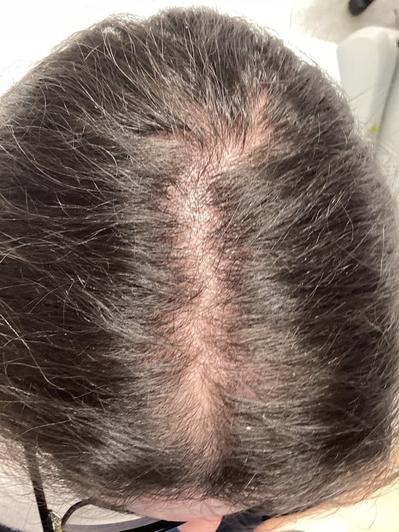 Optimal Platelet Concentration™ Therapy Before & After Gallery - Patient 289639 - Image 1