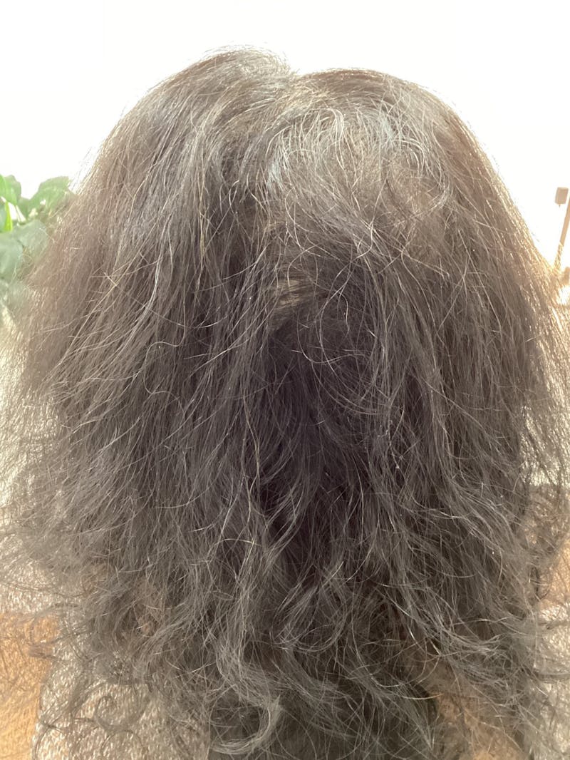 Painless PRP Before & After Gallery - Patient 377932 - Image 2