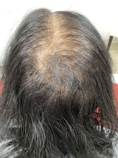 Androgenic Alopecia Before & After Gallery - Patient 327299 - Image 1