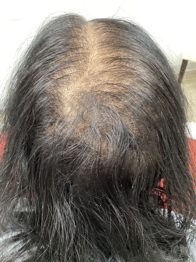 Painless PRP Before & After Gallery - Patient 377932 - Image 1