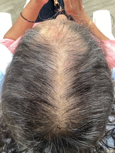 Androgenic Alopecia Before & After Gallery - Patient 233563 - Image 2