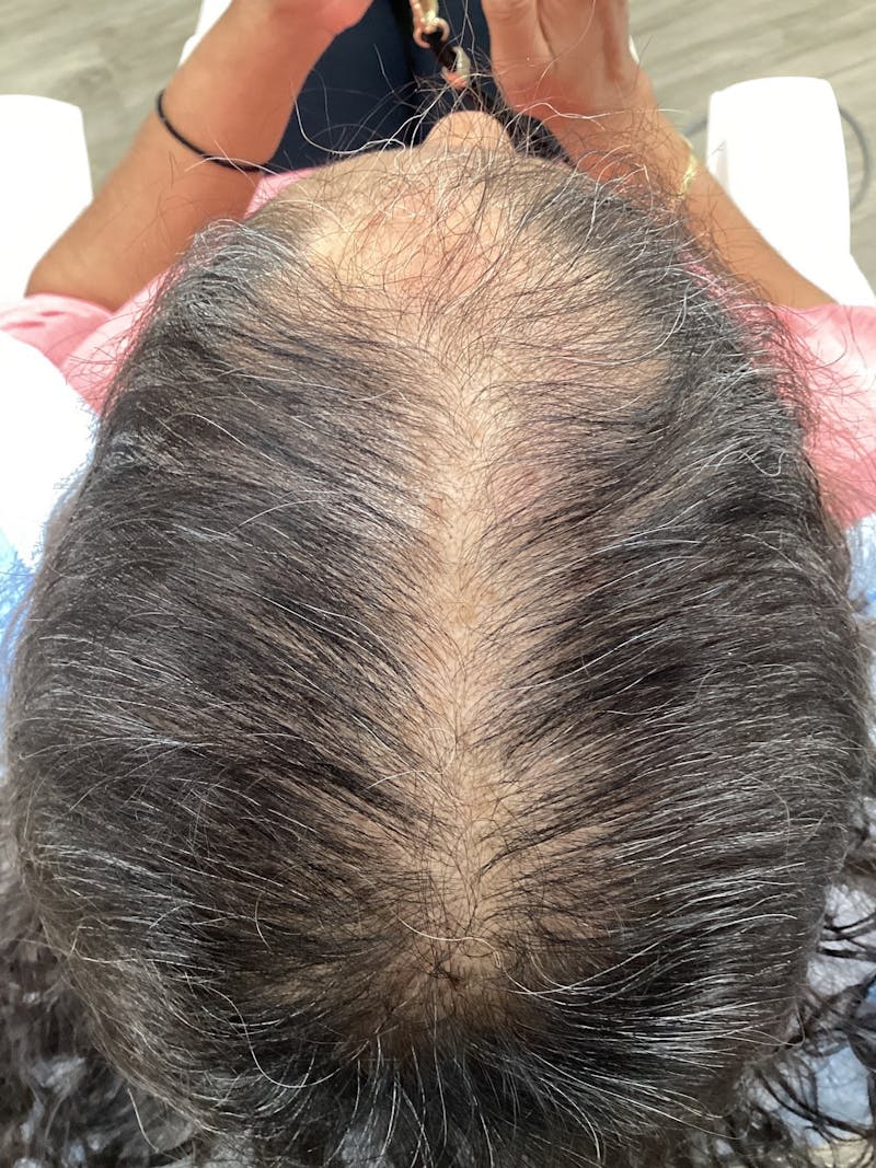 Painless PRP Before & After Gallery - Patient 362401 - Image 2