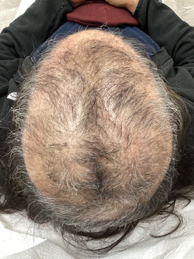 Androgenic Alopecia Before & After Gallery - Patient 233563 - Image 1