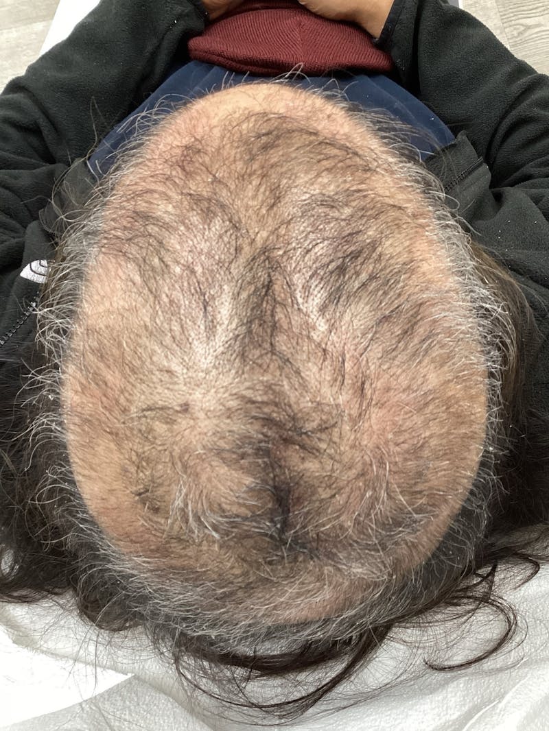 Painless PRP Before & After Gallery - Patient 362401 - Image 1