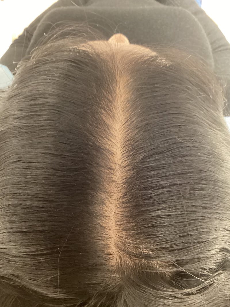 Androgenic Alopecia Before & After Gallery - Patient 407652 - Image 2