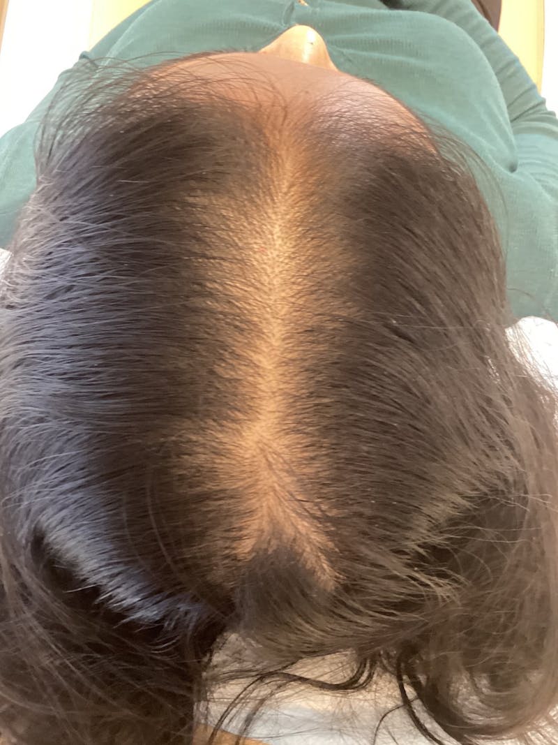 Androgenic Alopecia Before & After Gallery - Patient 407652 - Image 1