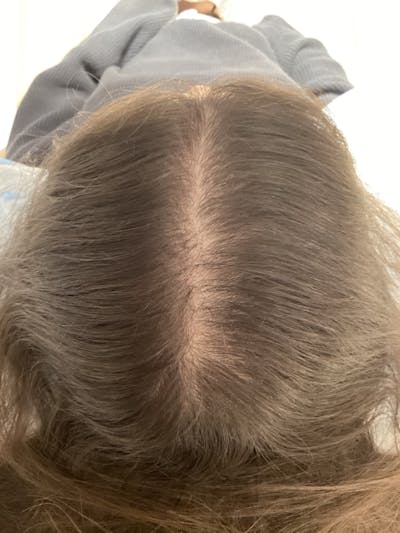 Painless PRP Before & After Gallery - Patient 295836 - Image 2