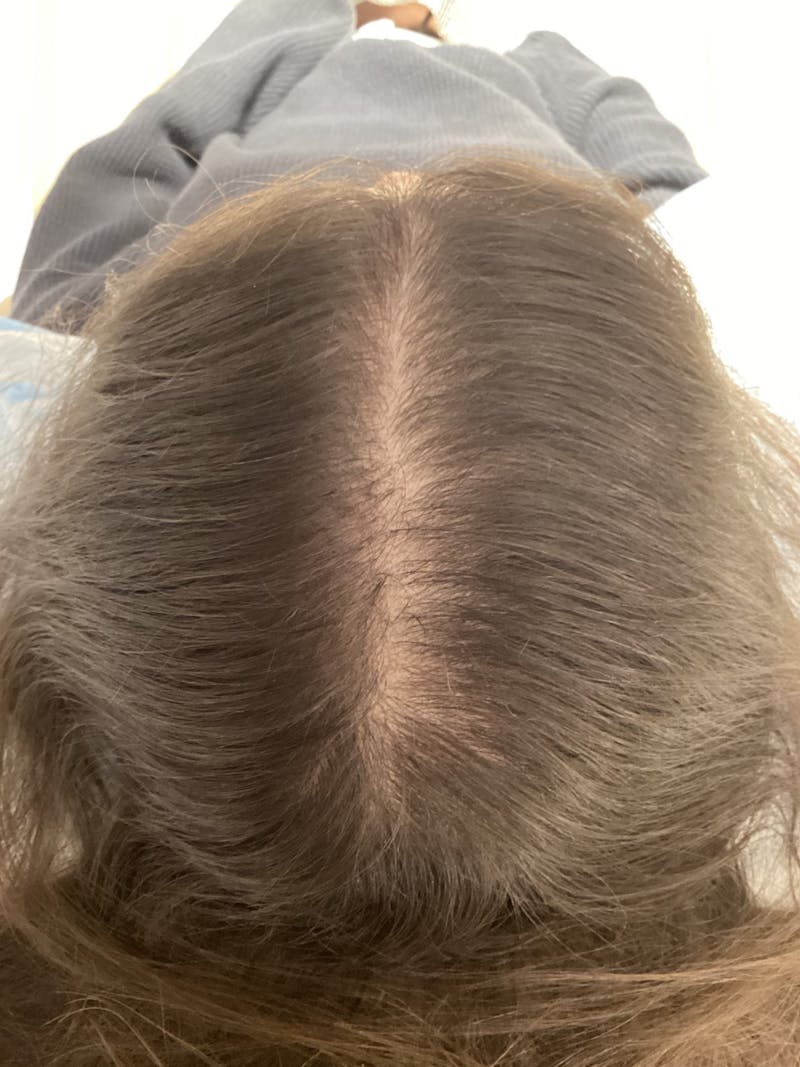 Painless PRP Before & After Gallery - Patient 295836 - Image 2