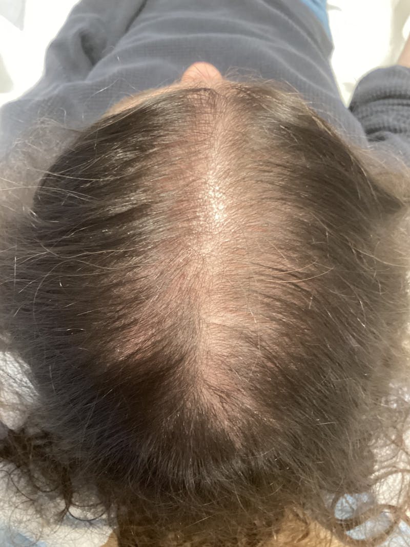 Painless PRP Before & After Gallery - Patient 295836 - Image 1
