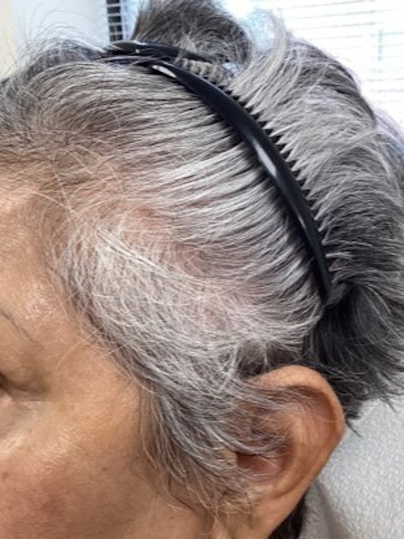 Androgenic Alopecia Before & After Gallery - Patient 281629 - Image 2