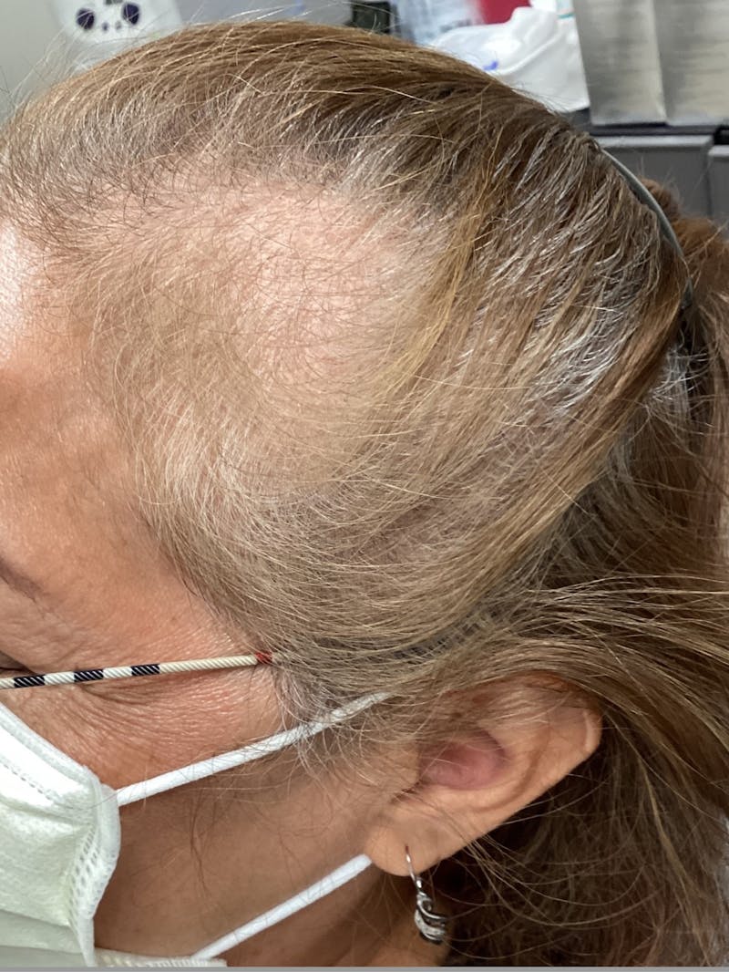 Androgenic Alopecia Before & After Gallery - Patient 281629 - Image 1